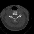 Occipital condyle fracture (Radiopaedia 31755-32691 Axial bone window 34).jpg