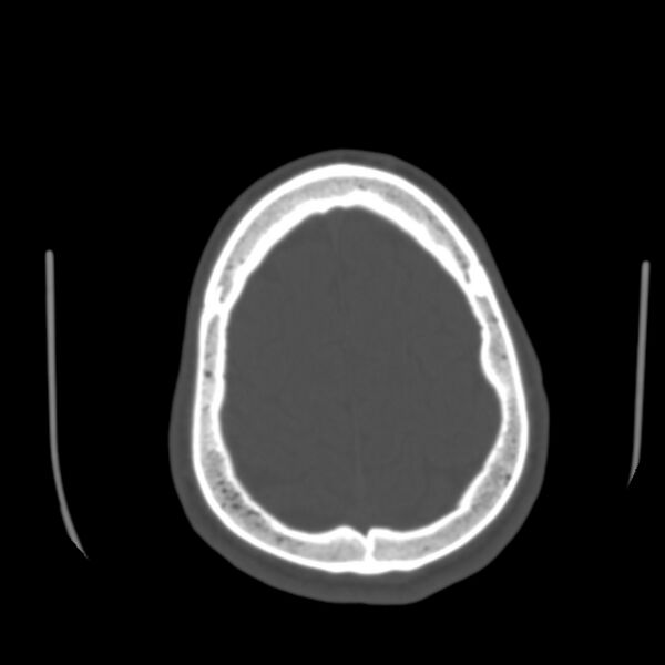 File:Occipital spur - asymptomatic (Radiopaedia 87753-104201 Axial bone window 180).jpg