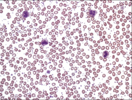 Thrombocytosis without obvious morphologic abnormalities of white blood cells and erythrocytes