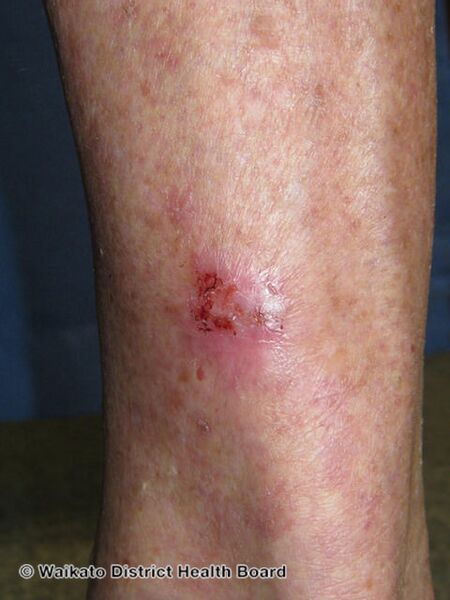 File:Superficial basal cell carcinoma, leg (DermNet NZ sbcc-leg-17-wdhb).jpg