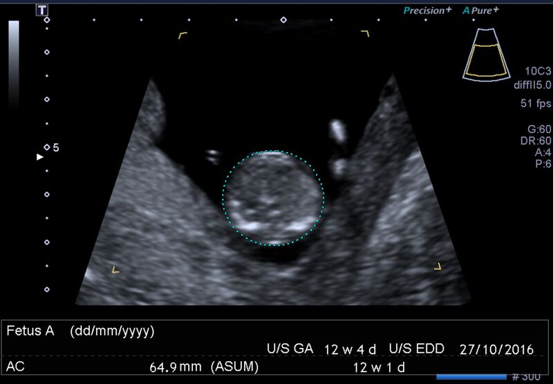 File:1st trimester nuchal-morphology ultrasound (Radiopaedia 44706-48477 General anatomy and NT 41).jpg