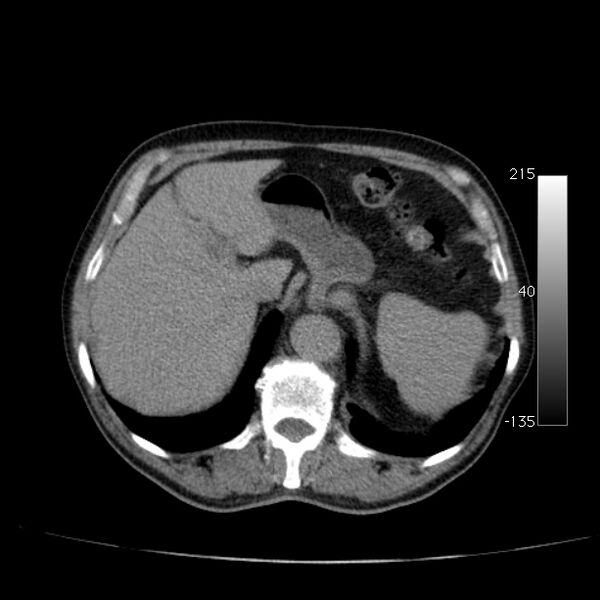File:Abdominal aortic aneurysm (Radiopaedia 29248-29660 Axial non-contrast 14).jpg
