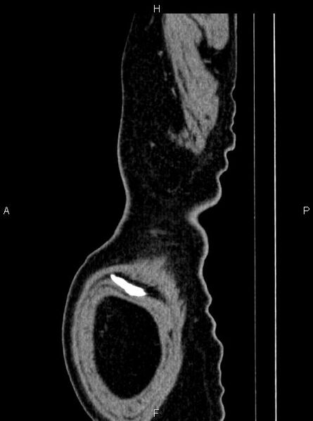 File:Abdominal aortic aneurysm (Radiopaedia 83094-97462 Sagittal renal cortical phase 123).jpg