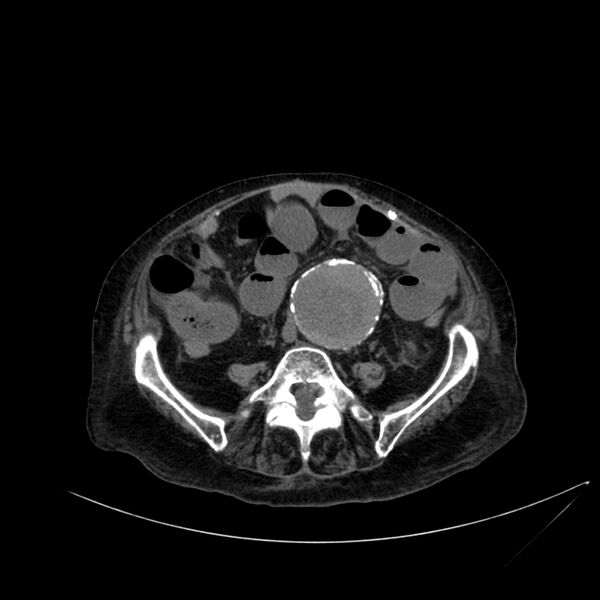 File:Abdominal aortic aneurysm - impending rupture (Radiopaedia 19233-19246 Axial non-contrast 82).jpg