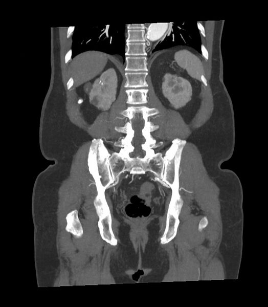 File:Abdominal aortic aneurysm with thrombus fissuration (Radiopaedia 46218-50618 Coronal C+ arterial phase 8).jpg