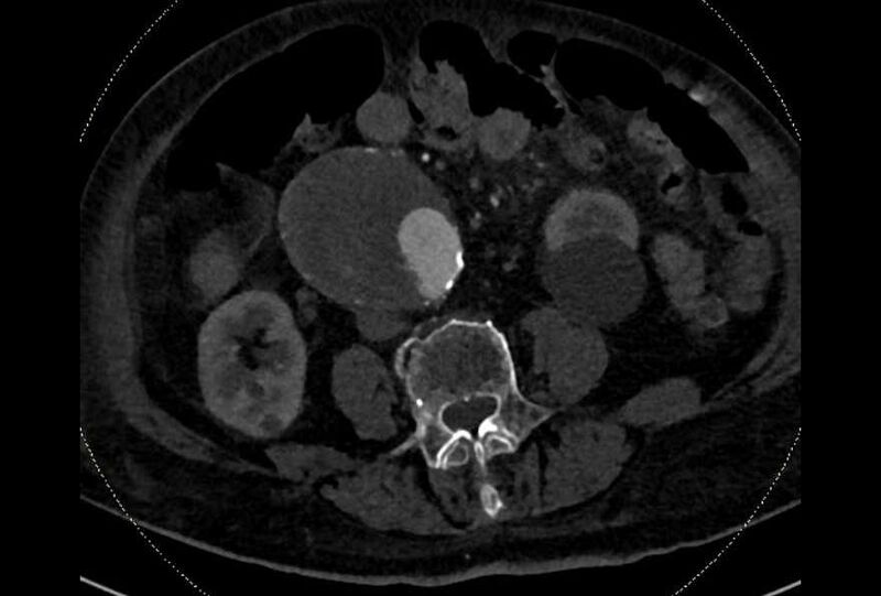 File:Abdominal aortic aneurysm with thrombus fissuration (Radiopaedia 73192-83919 Axial C+ arterial phase 119).jpg