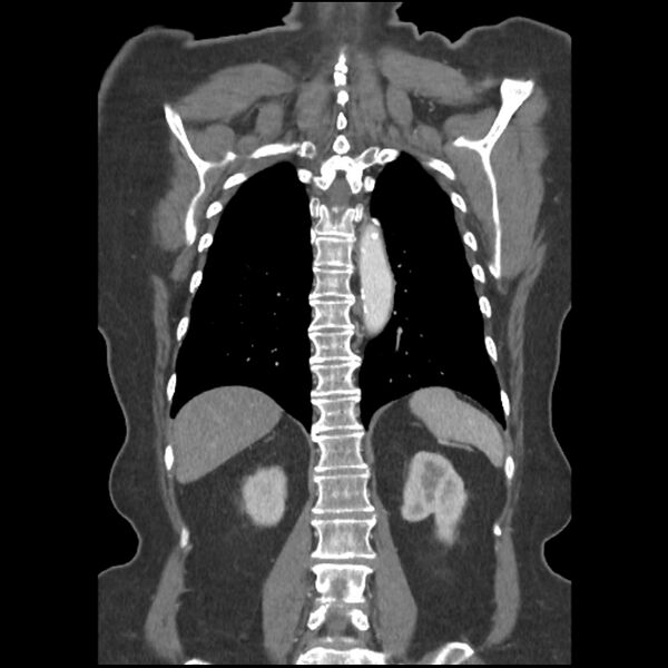 File:Aberrant right subclavian and left vertebral arteries (Radiopaedia 43467-46847 Coronal C+ portal venous phase 66).jpg
