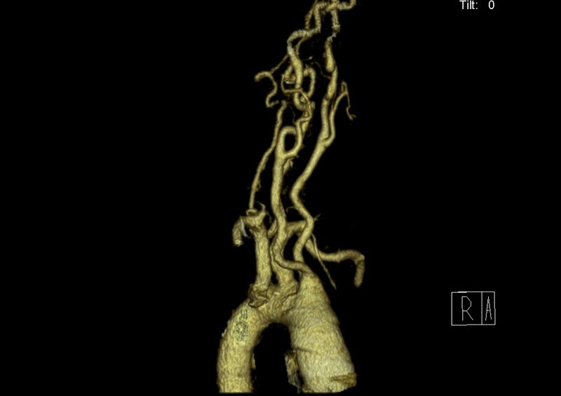 File:Aberrant right subclavian artery (Radiopaedia 19283-19294 3D reconstruction C+ arterial phase 32).jpg