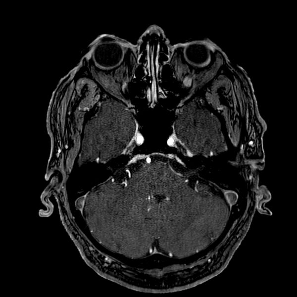 File:Accessory middle cerebral artery (Radiopaedia 73114-83828 Axial MRA 38).jpg