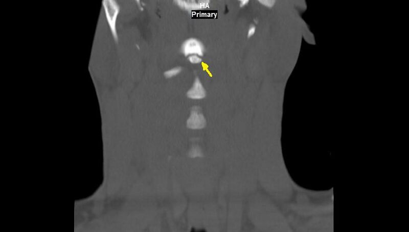 File:Accessory ossicle of the anterior arch of C1 vertebra (Radiopaedia 58149-65211 Coronal bone window 2).jpg