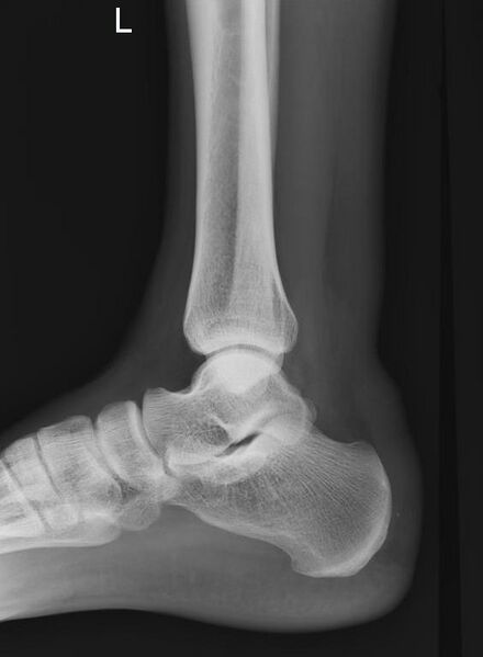 File:Achilles tendon tear (Radiopaedia 9759-10363 B 1).jpg
