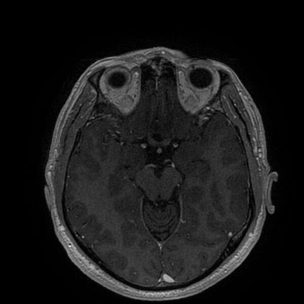 File:Acoustic schwannoma - intracanalicular (Radiopaedia 37247-39024 Axial T1 C+ 106).jpg