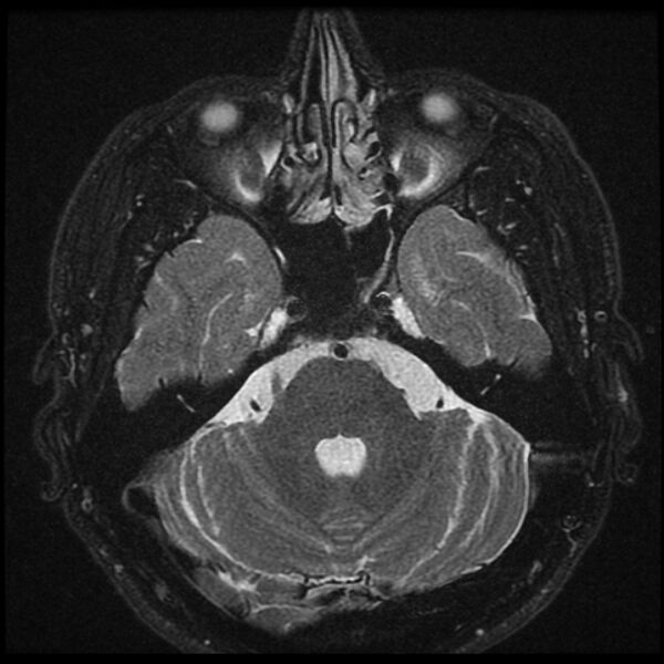 File:Acoustic schwannoma - intracanalicular (Radiopaedia 37247-39024 Axial T2 fat sat 9).jpg