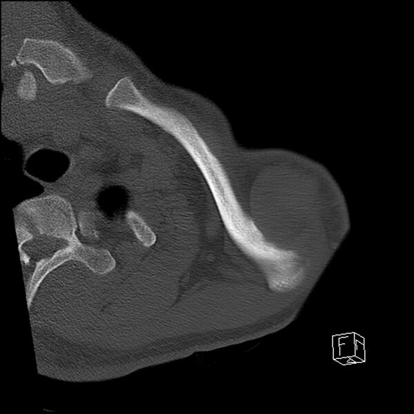 File:Acromioclavicular joint dissociation - type IV (Radiopaedia 64411-73216 Axial bone window 5).jpg