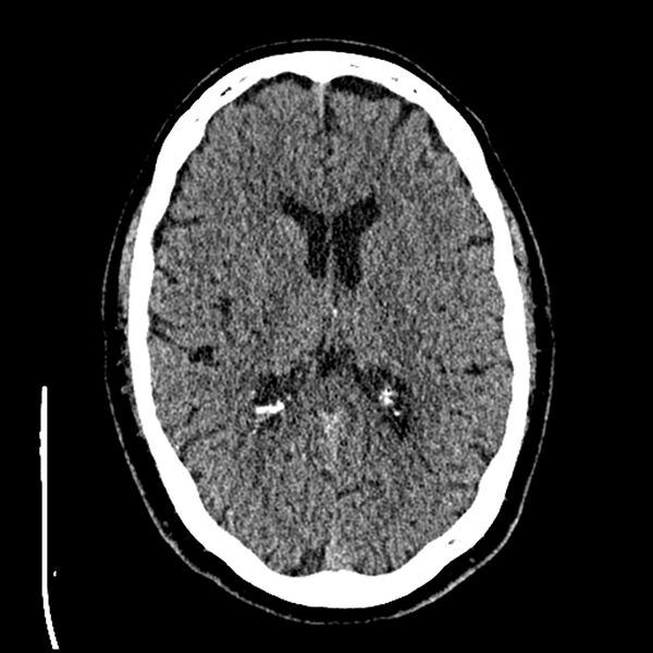 File:Acute A3 occlusion with ACA ischemic penumbra (CT perfusion) (Radiopaedia 72036-82525 Axial non-contrast thins 46).jpg
