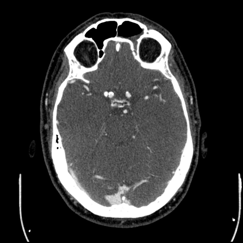 Acute A3 occlusion with ACA ischemic penumbra (CT perfusion) (Radiopaedia 72036-82527 Axial C+ arterial phase thins 112).jpg