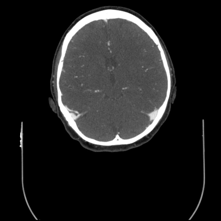 Acute M1 occlusion with ischemic penumbra (CT perfusion) (Radiopaedia 71897-82344 Axial C+ arterial phase thins 58).jpg