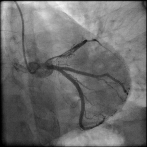 File:Acute anteroseptal myocardial infarction (Radiopaedia 68409-77946 LAO caudal (spider view) LAD and CX 32).jpg