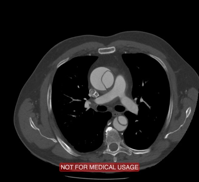 File:Acute aortic dissection - Stanford type A (Radiopaedia 40661-43285 Axial C+ arterial phase 22).jpg