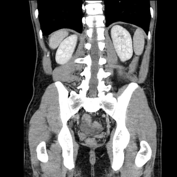 File:Acute appendicitis (Radiopaedia 27049-27227 Coronal C+ portal venous phase 42).jpg