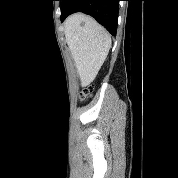 File:Acute appendicitis (Radiopaedia 27049-27227 Sagittal C+ portal venous phase 11).jpg