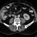 Acute appendicitis arising from a malrotated cecum (Radiopaedia 19970-19997 Axial C+ portal venous phase 20).jpg