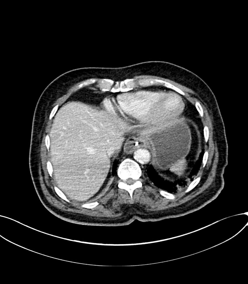 Acute arterial mesenteric ischemia (Radiopaedia 78238-90828 Axial C+ portal venous phase 22).jpg