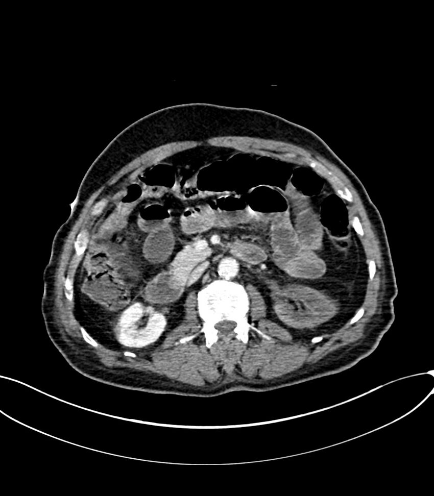 Acute arterial mesenteric ischemia (Radiopaedia 78238-90828 Axial C+ portal venous phase 57).jpg
