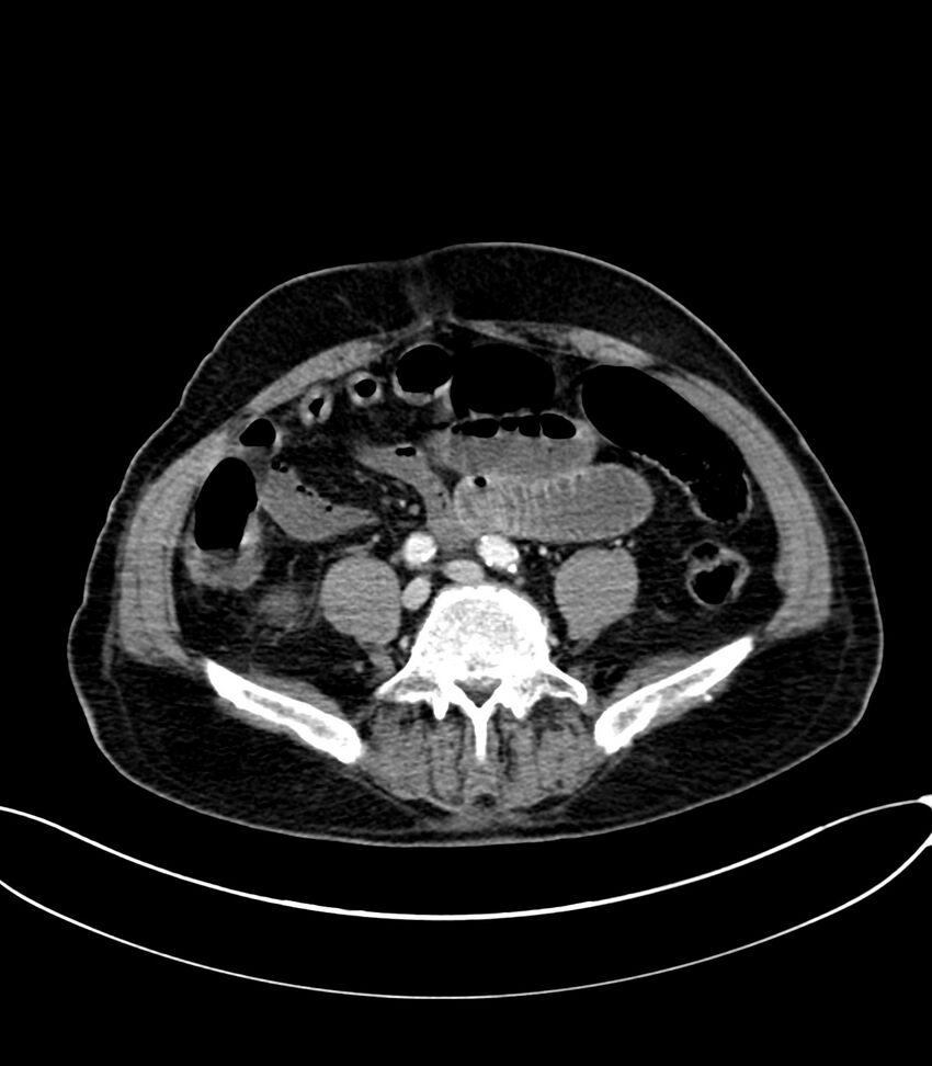 Acute arterial mesenteric ischemia (Radiopaedia 78238-90828 Axial C+ portal venous phase 94).jpg
