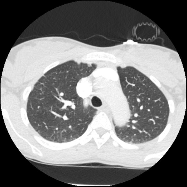 File:Acute chest syndrome - sickle cell disease (Radiopaedia 42375-45499 Axial lung window 57).jpg