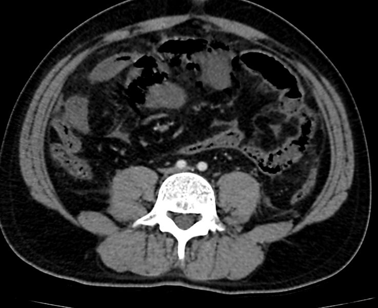 File:Acute mesenteric ischemia - superior mesenteric artery thrombosis (Radiopaedia 73947-84776 Axial C+ arterial phase 92).jpg