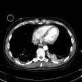 Acute myocardial infarction in CT (Radiopaedia 39947-42415 Axial C+ arterial phase 103).jpg