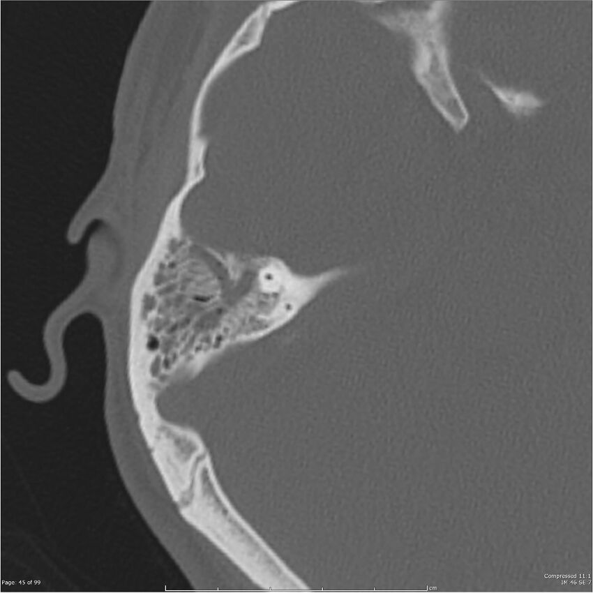 Acute otomastoiditis (Radiopaedia 28276-28512 Axial PTB bone window reformat 25).jpg