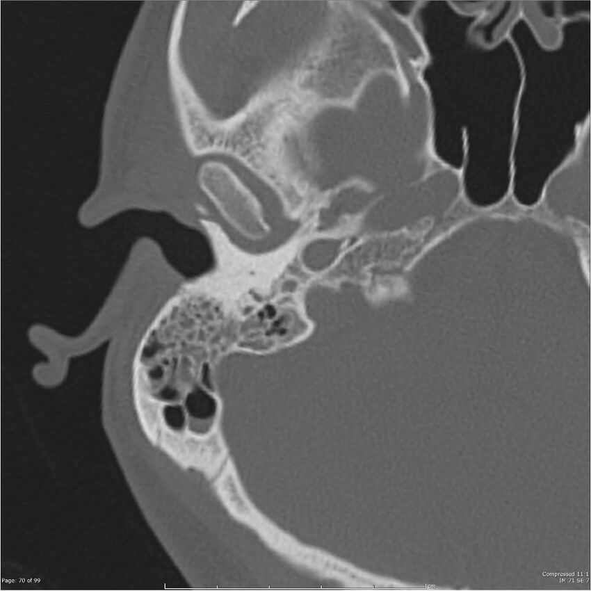 Acute otomastoiditis (Radiopaedia 28276-28512 Axial PTB bone window reformat 50).jpg