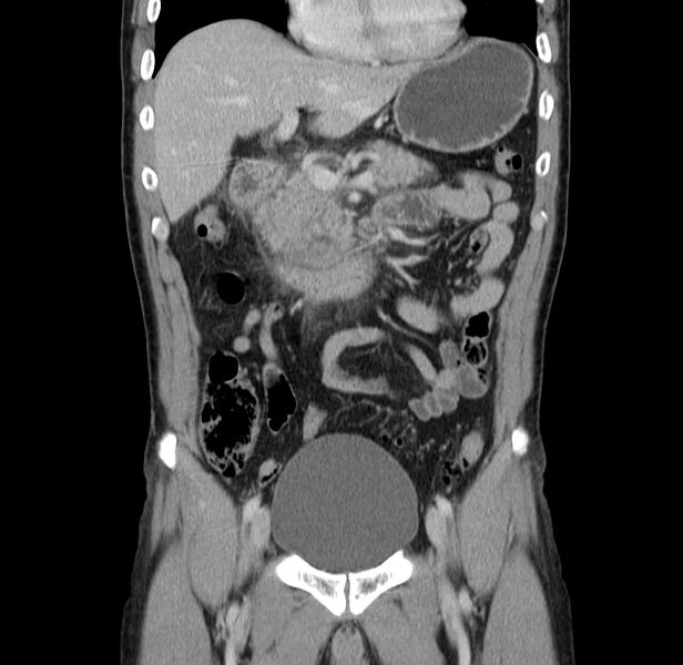 File:Acute pancreatitis (Radiopaedia 22572-22596 Coronal C+ portal venous phase 21).jpg