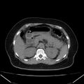Acute pancreatitis - Balthazar C (Radiopaedia 26569-26714 Axial non-contrast 32).jpg