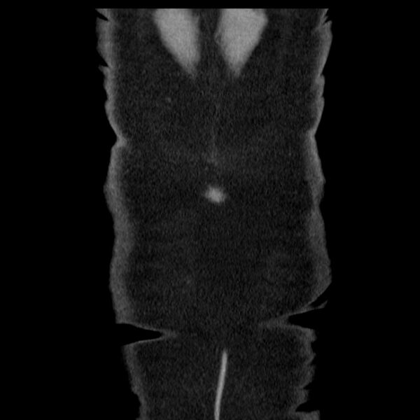 File:Acute pancreatitis - Balthazar C (Radiopaedia 26569-26714 Coronal C+ portal venous phase 70).jpg