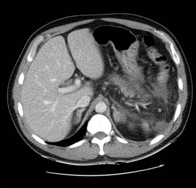 File:Acute pancreatitis - Balthazar E (Radiopaedia 23080-23110 Axial C+ portal venous phase 17).jpg