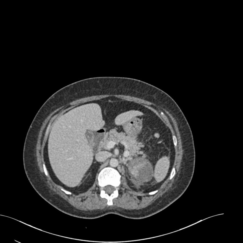 Acute pyelonephritis with renal vein thrombosis (Radiopaedia 58020-65053 Axial renal parenchymal phase 22).jpg