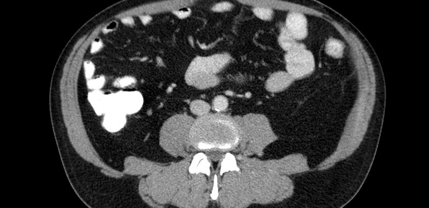 Acute sigmoid colon diverticulitis (Radiopaedia 55507-61976 Axial C+ portal venous phase 35).jpg