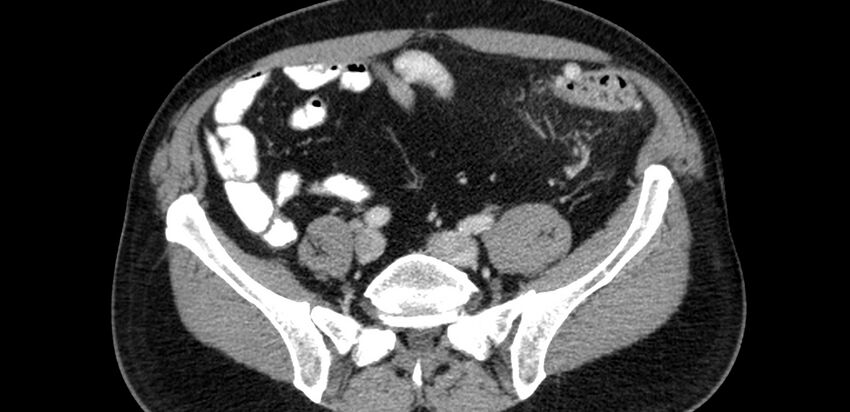 Acute sigmoid colon diverticulitis (Radiopaedia 55507-61976 Axial C+ portal venous phase 64).jpg
