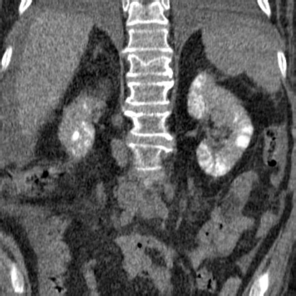 File:Acute tubular necrosis (Radiopaedia 28077-28334 Coronal non-contrast 11).jpg