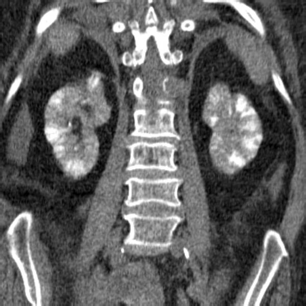 File:Acute tubular necrosis (Radiopaedia 28077-28334 Coronal non-contrast 23).jpg