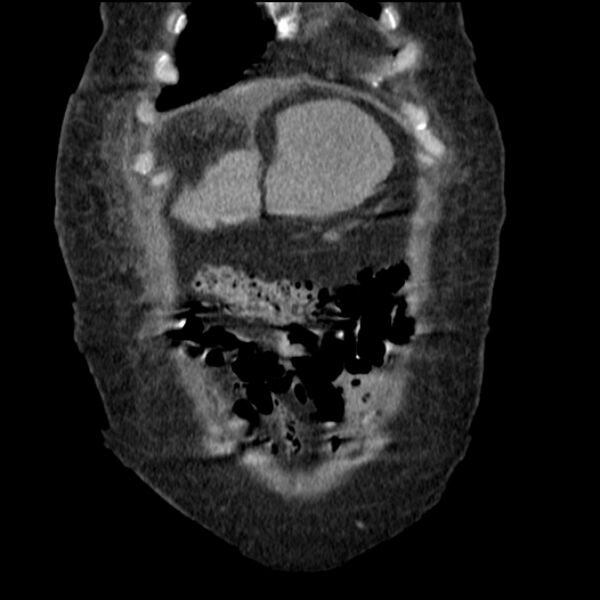 File:Acute tubular necrosis (Radiopaedia 28077-28334 G 18).jpg