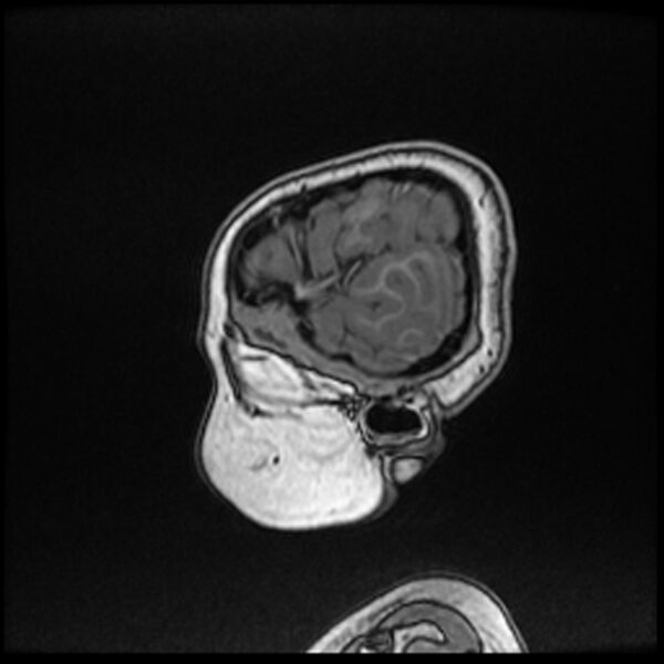 File:Adamantinomatous craniopharyngioma (Radiopaedia 77407-89529 Sagittal T1 C+ 12).jpg