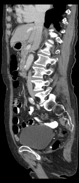File:Adenocarcinoma of cecum (Radiopaedia 59222-66549 Sagittal C+ portal venous phase 54).jpg