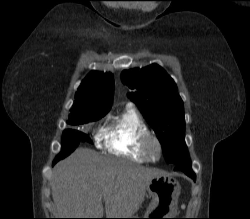 Adenocarcinoma of the lung (Radiopaedia 44205-47803 Coronal C+ portal venous phase 17).jpg