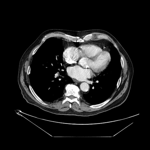 File:Adenocarcinoma of the lung (Radiopaedia 44876-48759 Axial C+ portal venous phase 51).jpg