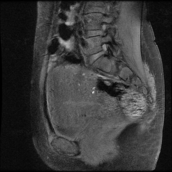 File:Adenomyosis on MRI (Radiopaedia 29328-29780 Sagittal T1 fat sat 11).jpg