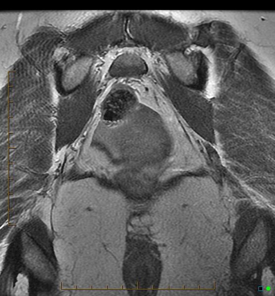 File:Adenomyosis uterus with hematometra (Radiopaedia 45779-50011 Coronal T2 23).jpg